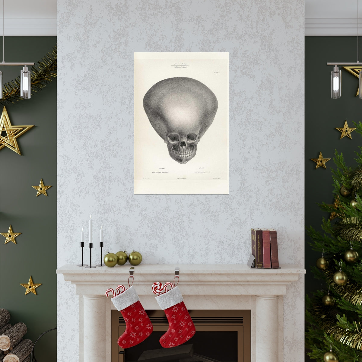 Joseph Vimont - Skull Of A Hydrocephalus Child Print Poster