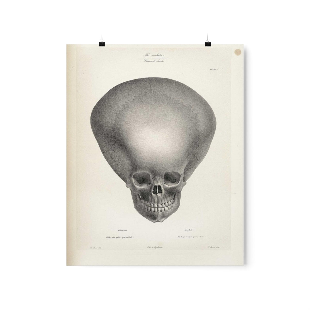 Joseph Vimont - Skull Of A Hydrocephalus Child Print Poster