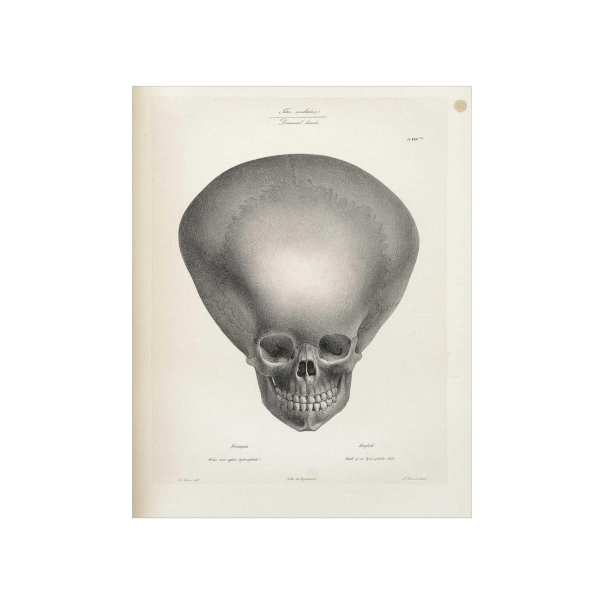 Joseph Vimont - Skull Of A Hydrocephalus Child Print Poster