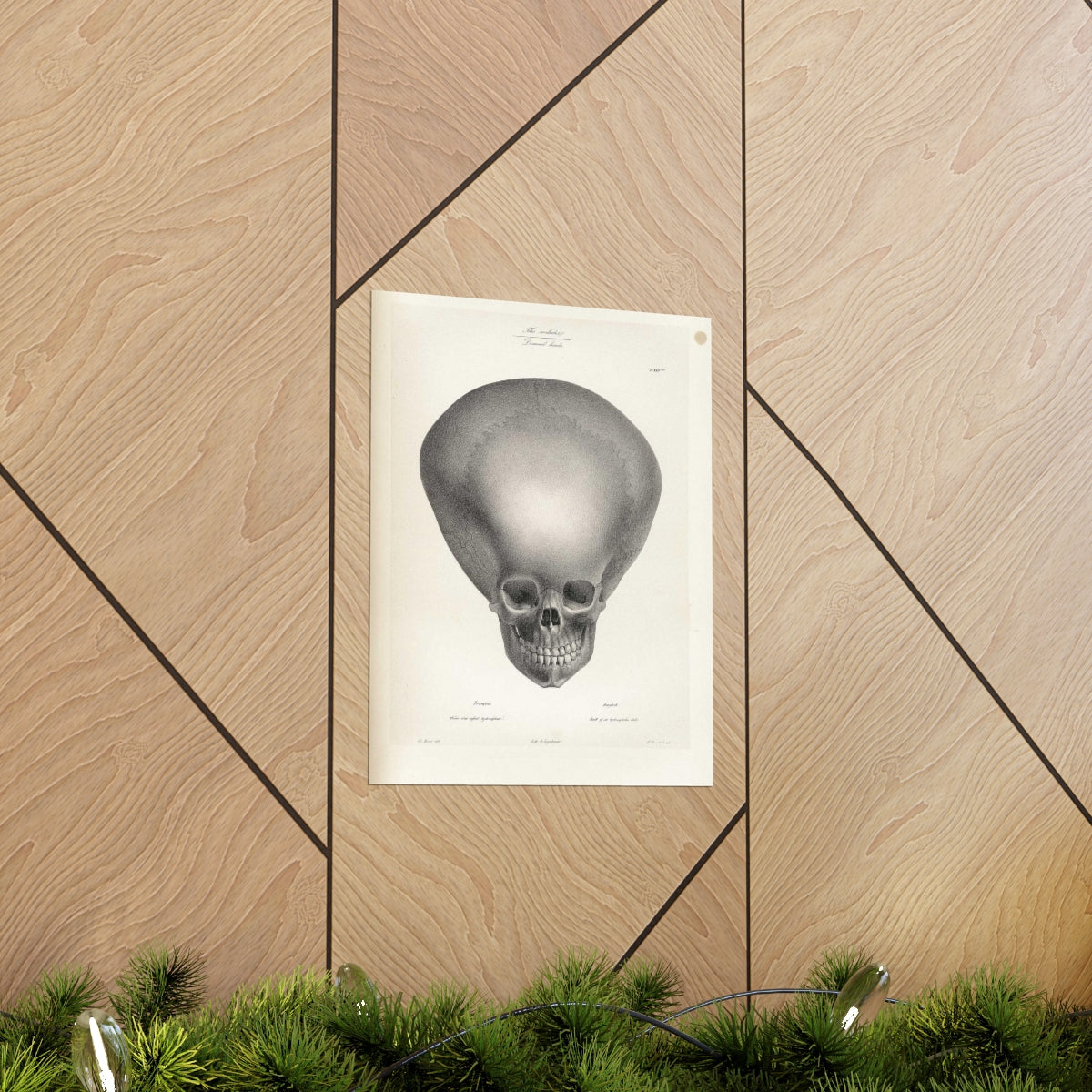 Joseph Vimont - Skull Of A Hydrocephalus Child Print Poster