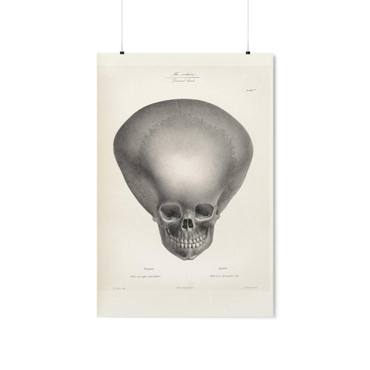 Joseph Vimont - Skull Of A Hydrocephalus Child Print Poster